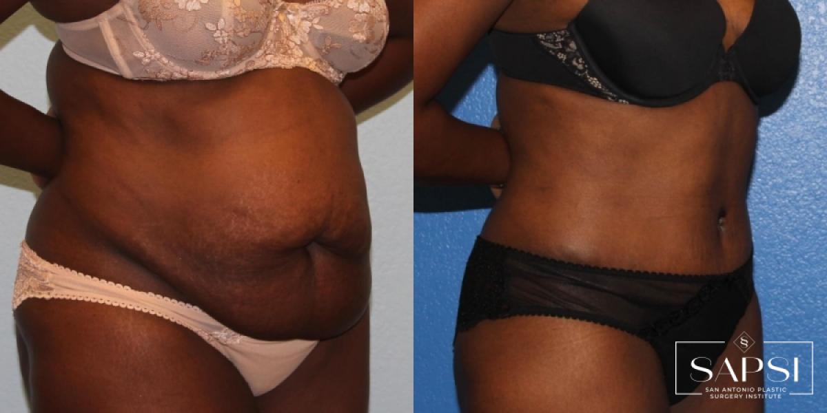 Tummy Tuck: Patient 18 - Before and After 2