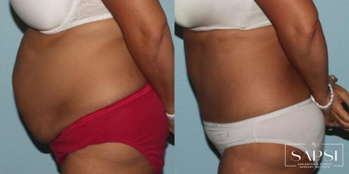 Tummy Tuck: Patient 27 - Before and After 3