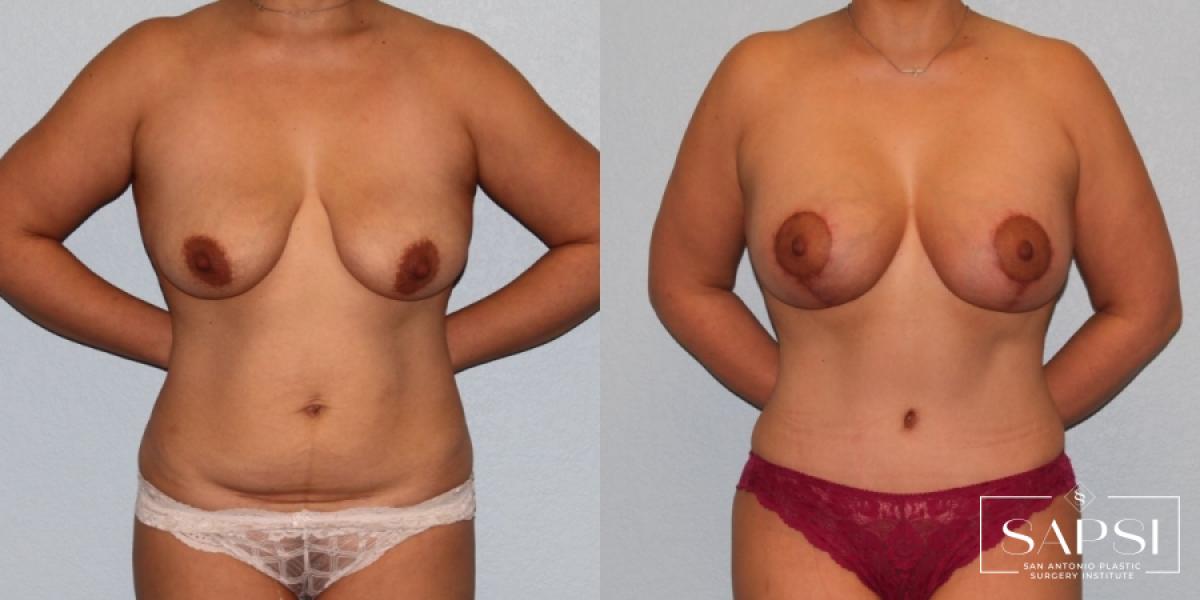 Breast Augmentation With Lift: Patient 7 - Before and After  