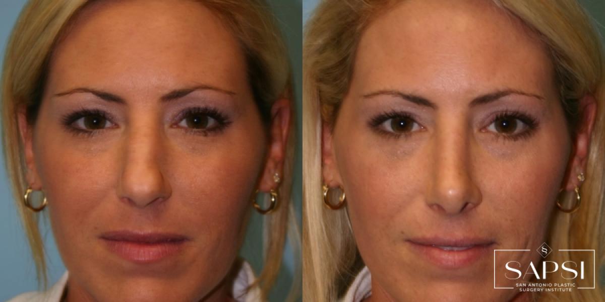 Facelift: Patient 4 - Before and After  