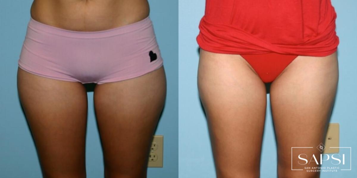 Liposuction: Patient 11 - Before and After 1