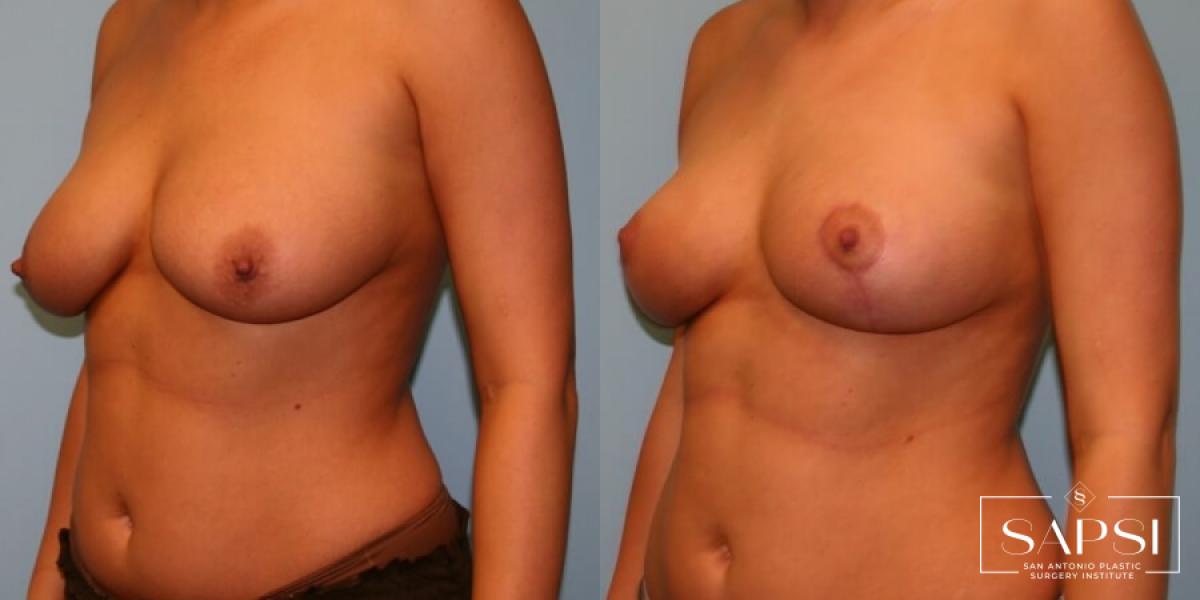 Breast Lift: Patient 13 - Before and After 3