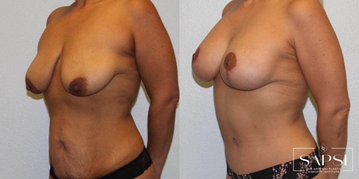 Body Contouring: Patient 8 - Before and After 2