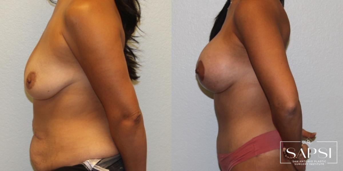 Breast Augmentation With Lift: Patient 8 - Before and After 3