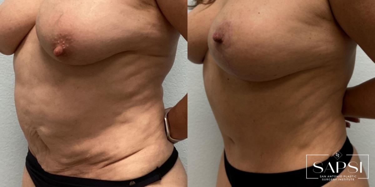 Tummy Tuck: Patient 8 - Before and After 2