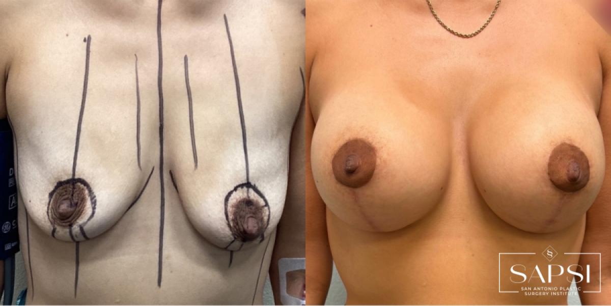 Breast Augmentation With Lift: Patient 22 - Before and After 1