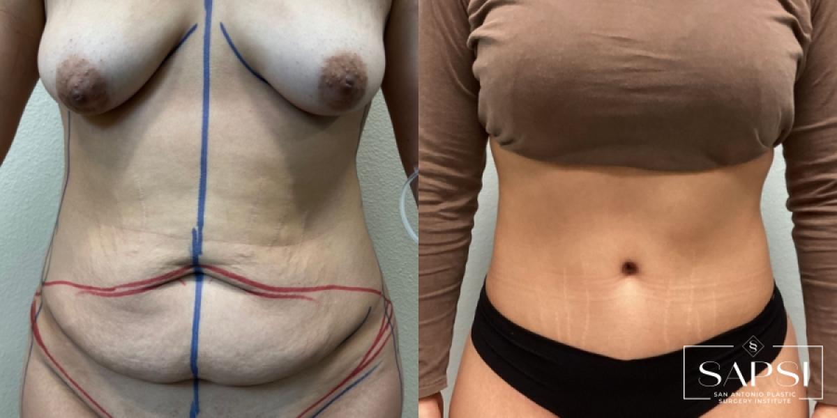 Tummy Tuck: Patient 3 - Before and After  