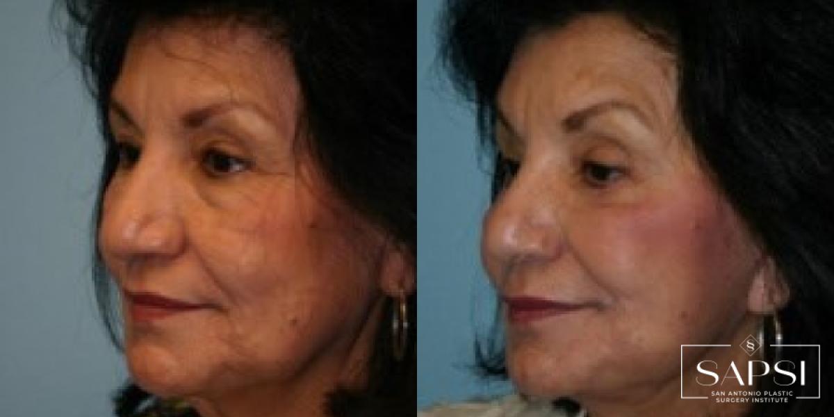 Facelift: Patient 5 - Before and After 2