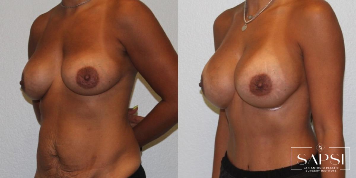 Breast Revision: Patient 4 - Before and After 2