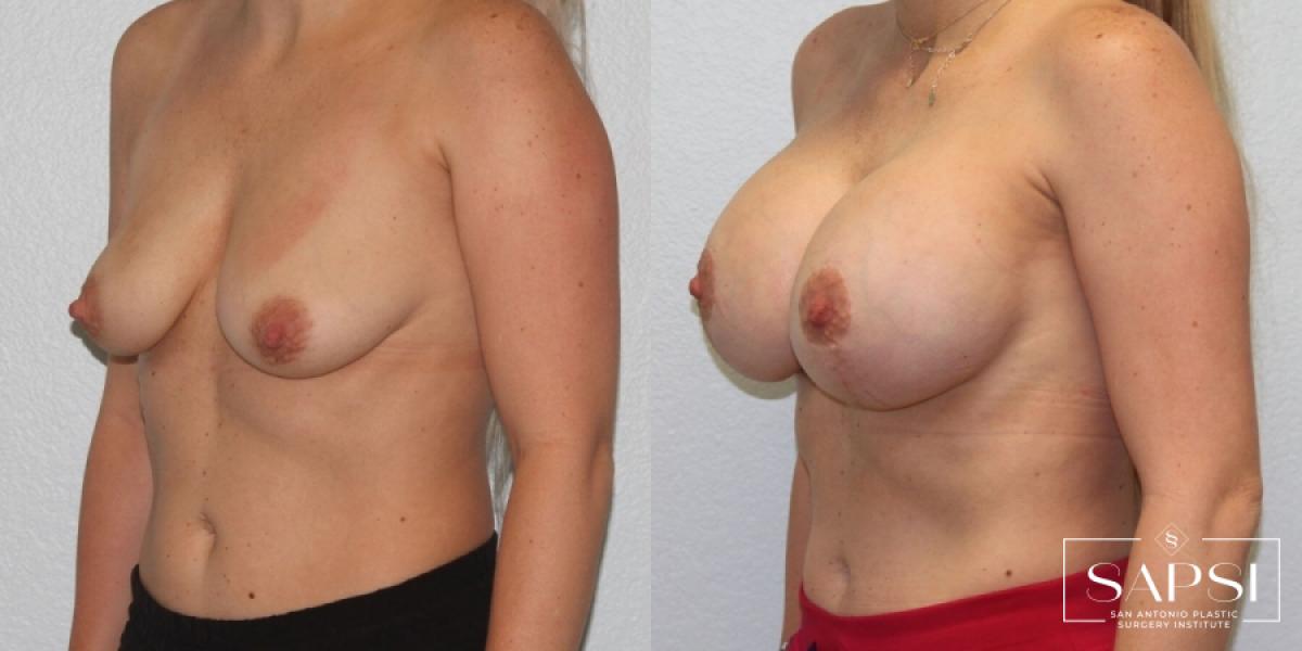 Breast Lift: Patient 4 - Before and After 2