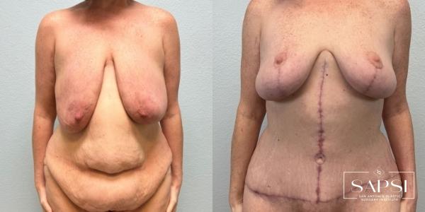 After Weight Loss: Patient 2 - Before and After  