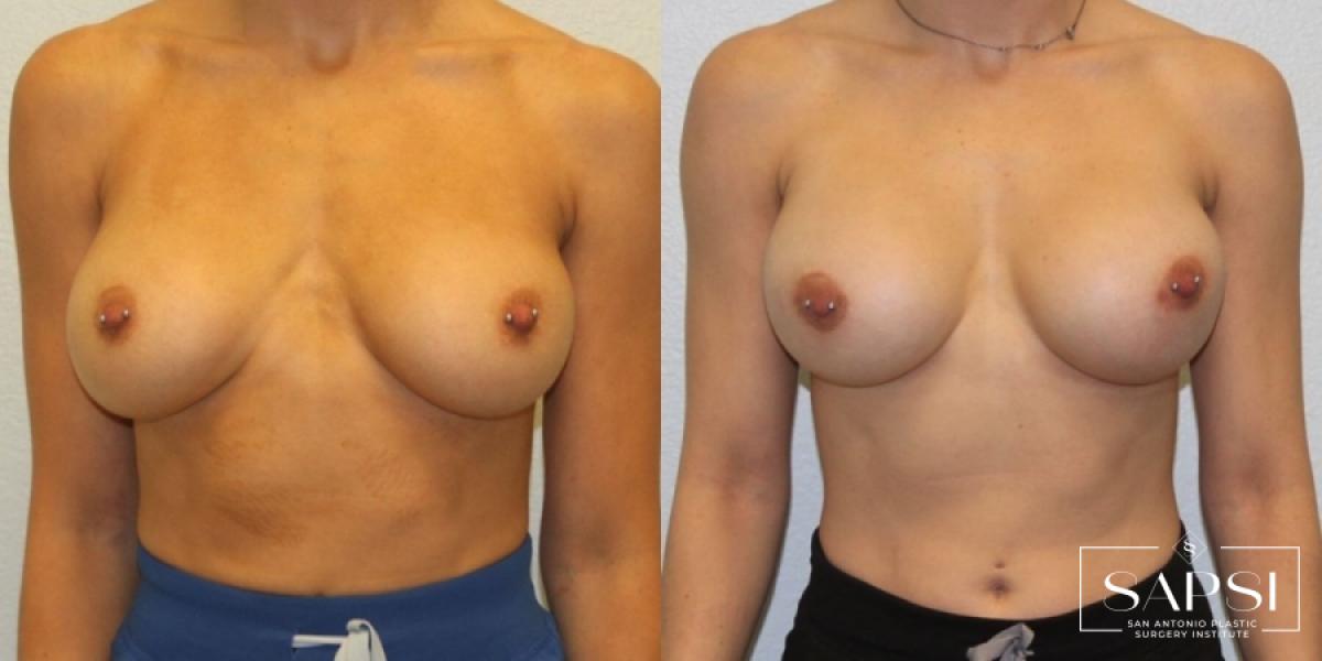 Breast Revision: Patient 1 - Before and After  