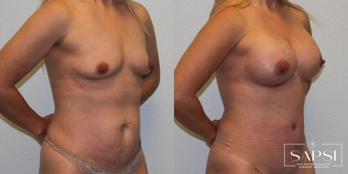 Breast Augmentation: Patient 57 - Before and After 2