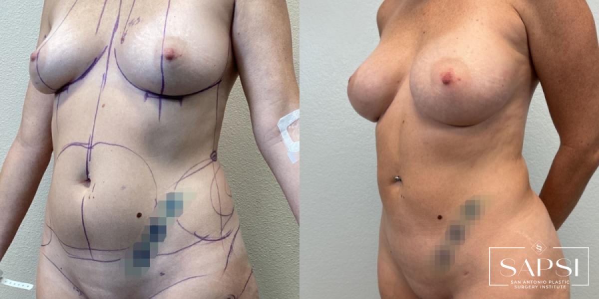 Liposuction: Patient 2 - Before and After  