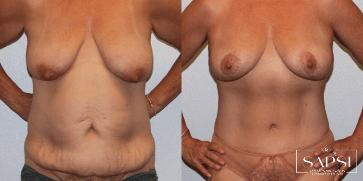 Breast Lift: Patient 11 - Before and After 1