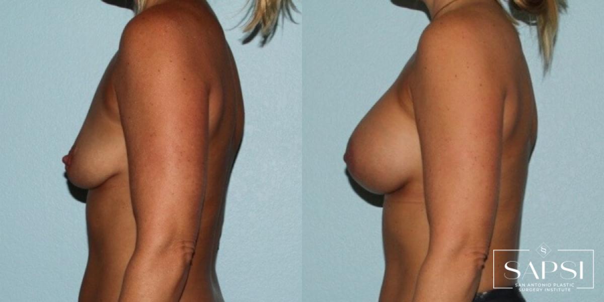 Breast Augmentation: Patient 15 - Before and After 3