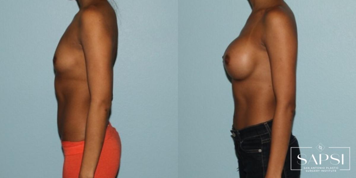 Breast Augmentation: Patient 43 - Before and After 3