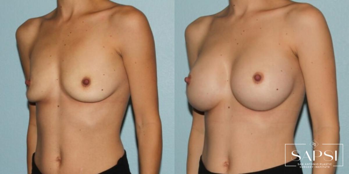 Breast Augmentation: Patient 11 - Before and After 2