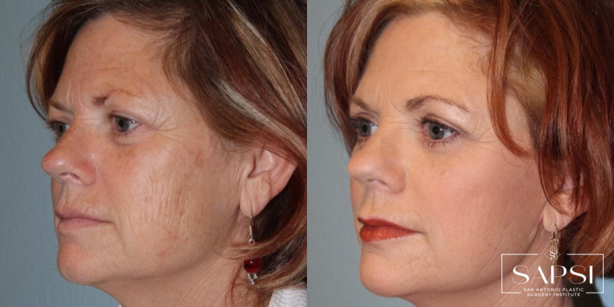 Facelift: Patient 6 - Before and After 2