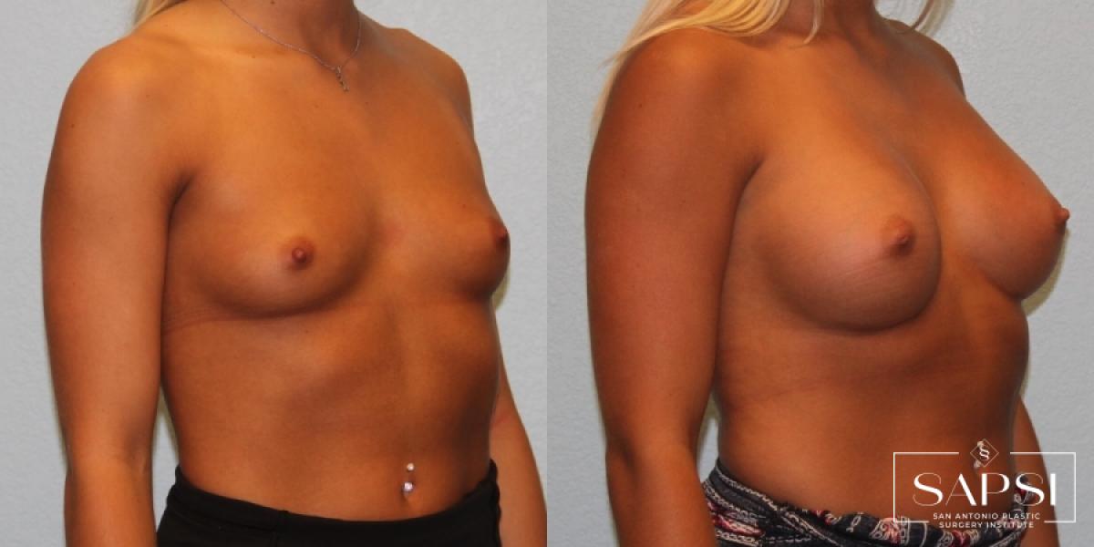 Breast Augmentation: Patient 22 - Before and After 2