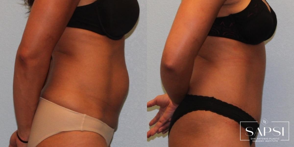 Tummy Tuck: Patient 49 - Before and After 3