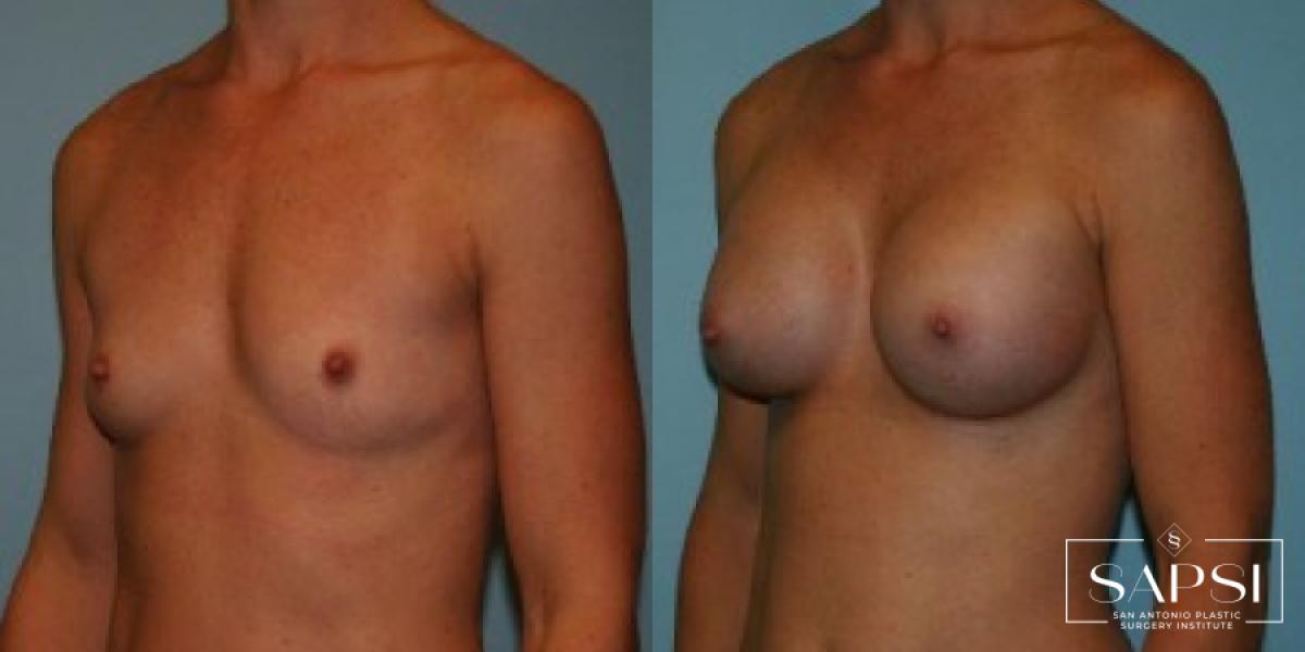 Breast Augmentation: Patient 85 - Before and After 2