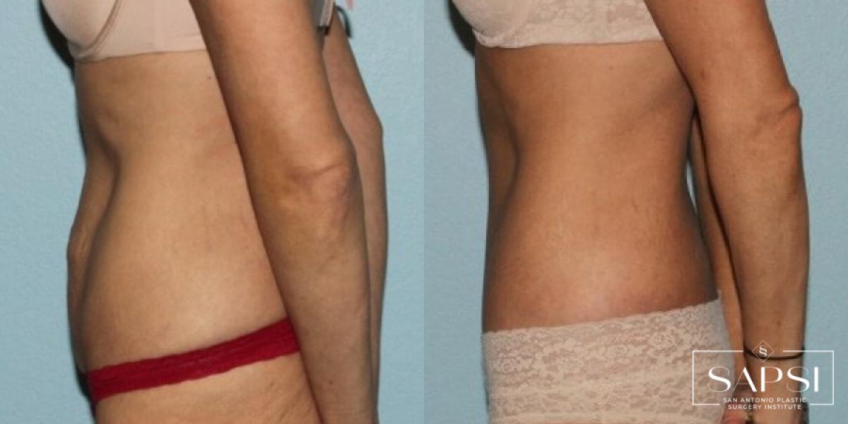 Tummy Tuck: Patient 28 - Before and After 3