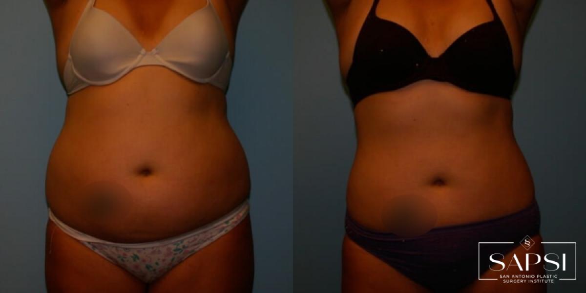 Liposuction: Patient 9 - Before and After  