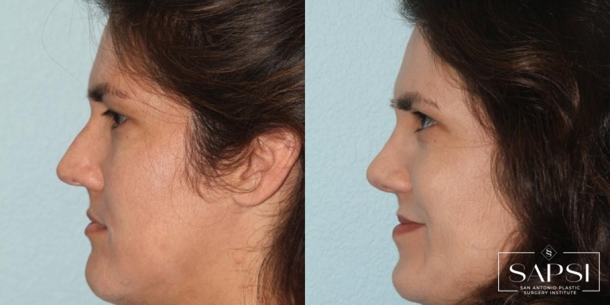 Facelift: Patient 1 - Before and After 3