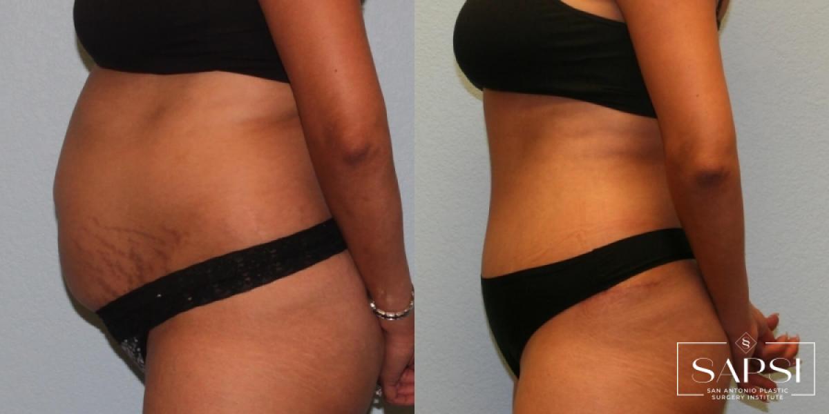 Tummy Tuck: Patient 15 - Before and After 3