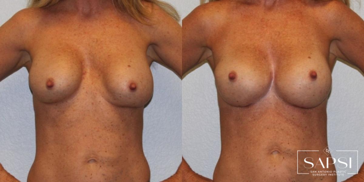 Breast Revision: Patient 7 - Before and After  