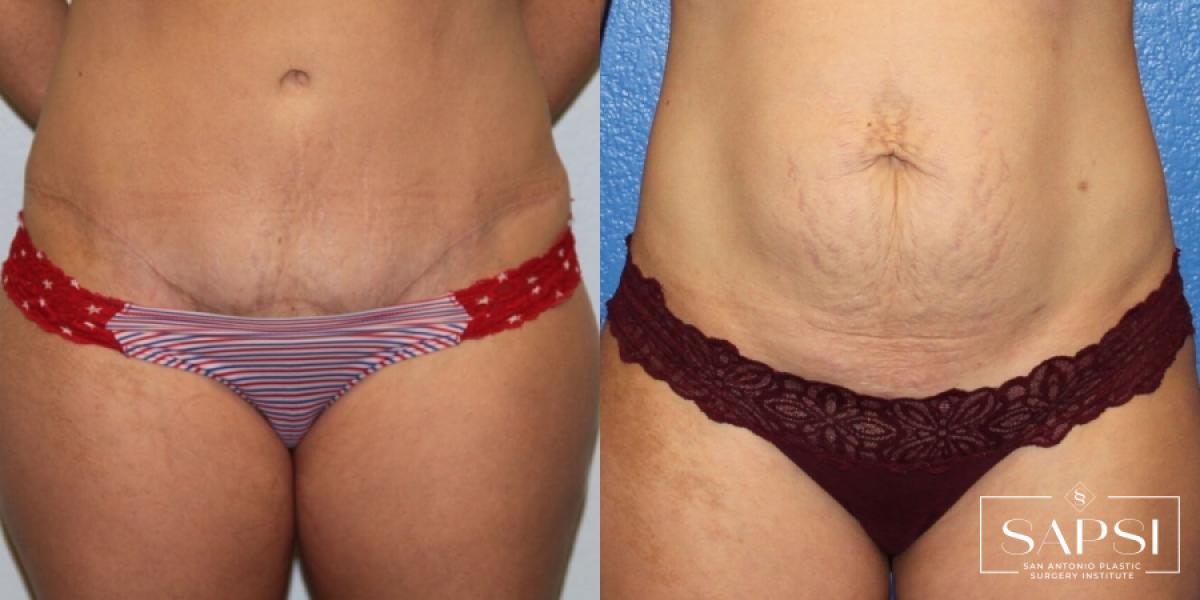 Tummy Tuck: Patient 36 - Before and After 4