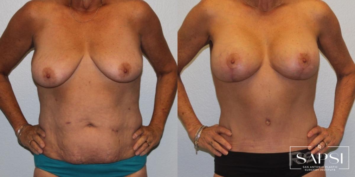 Breast Lift: Patient 8 - Before and After  