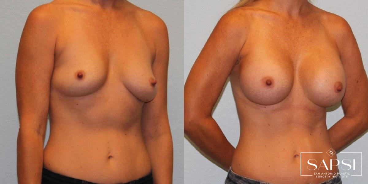 Breast Augmentation: Patient 19 - Before and After 2