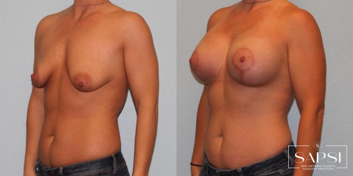 Breast Augmentation With Lift: Patient 11 - Before and After 2