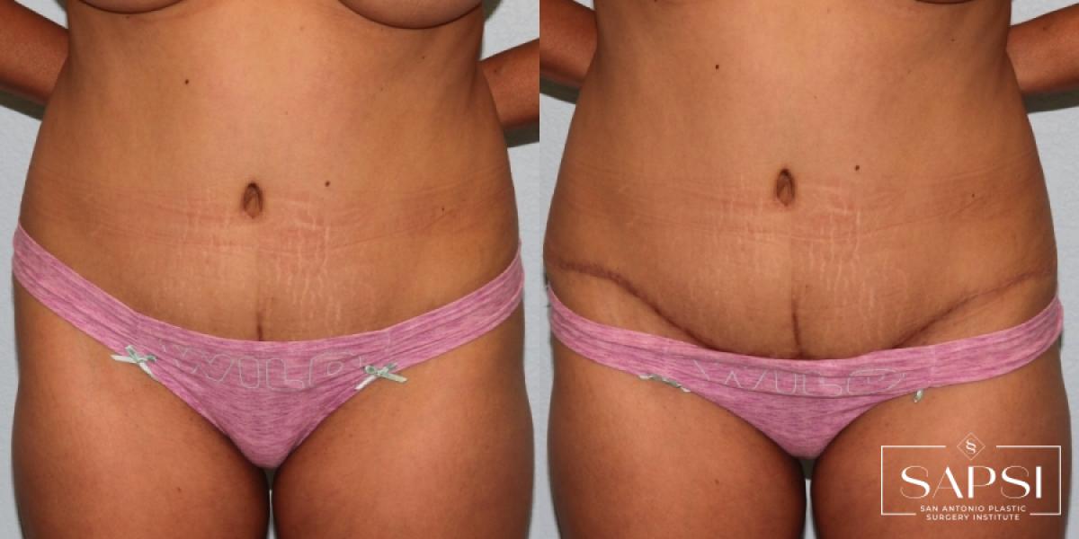 Tummy Tuck: Patient 37 - Before and After 4