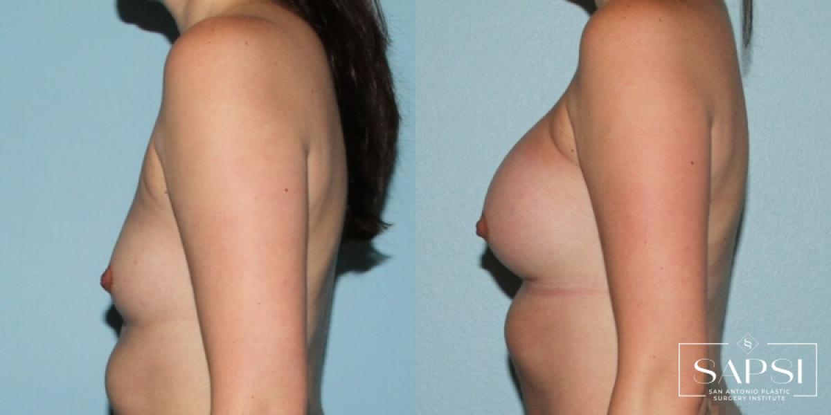 Breast Augmentation: Patient 8 - Before and After 3