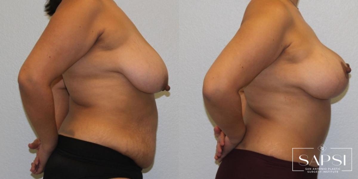 Breast Lift: Patient 2 - Before and After 3