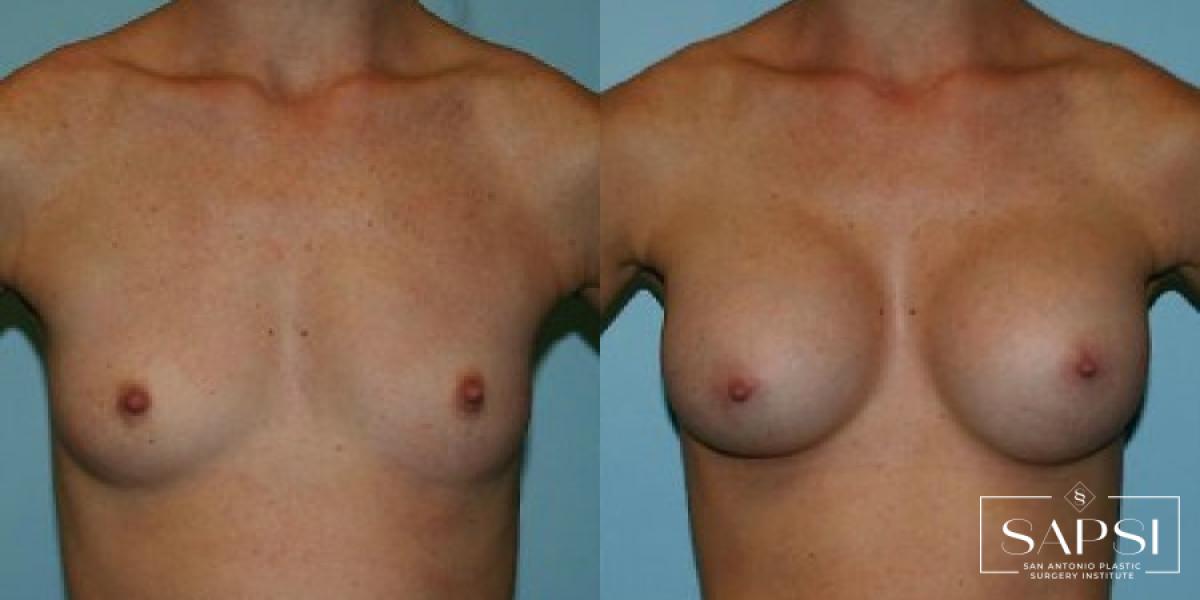 Breast Augmentation: Patient 85 - Before and After 1