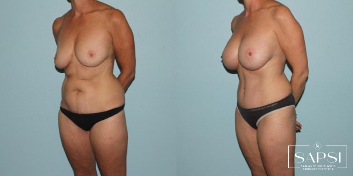 Breast Augmentation: Patient 44 - Before and After 2