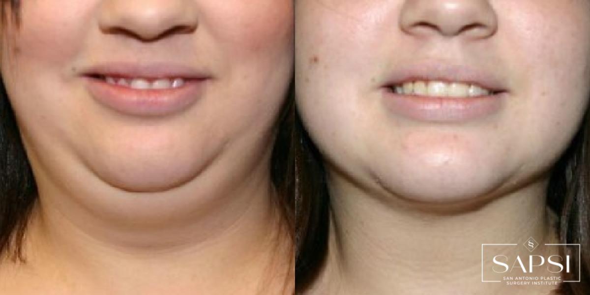 Liposuction: Patient 6 - Before and After  