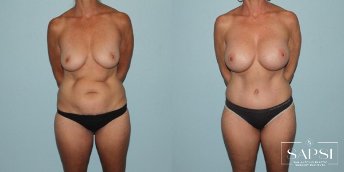 Tummy Tuck: Patient 11 - Before and After 1