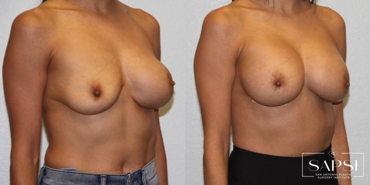 Breast Revision: Patient 8 - Before and After 2