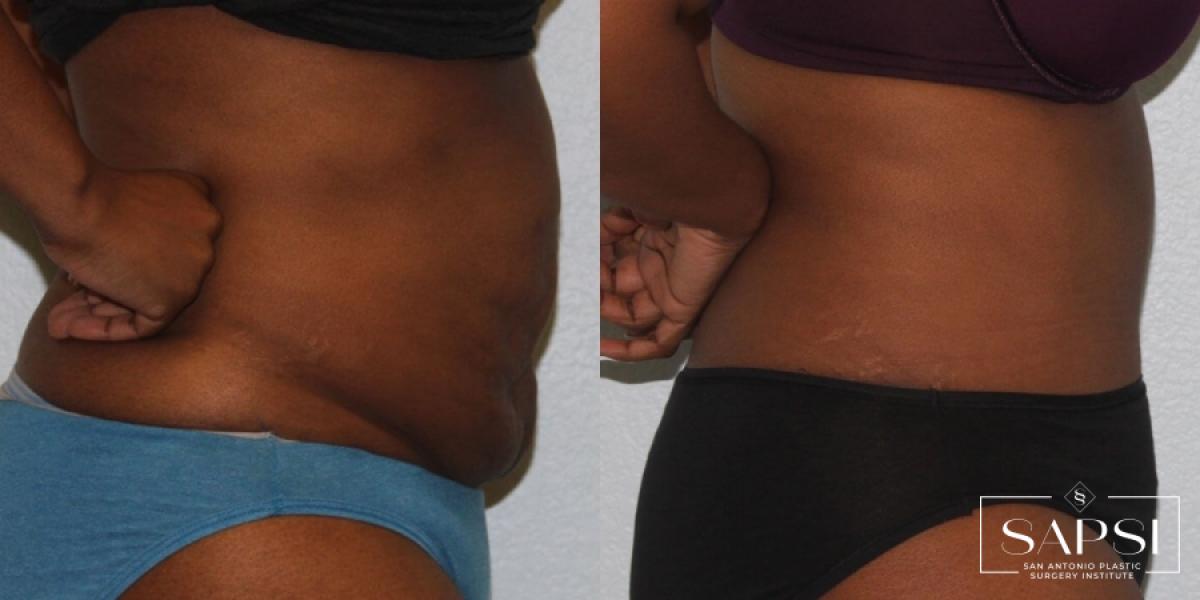 Tummy Tuck: Patient 25 - Before and After 3