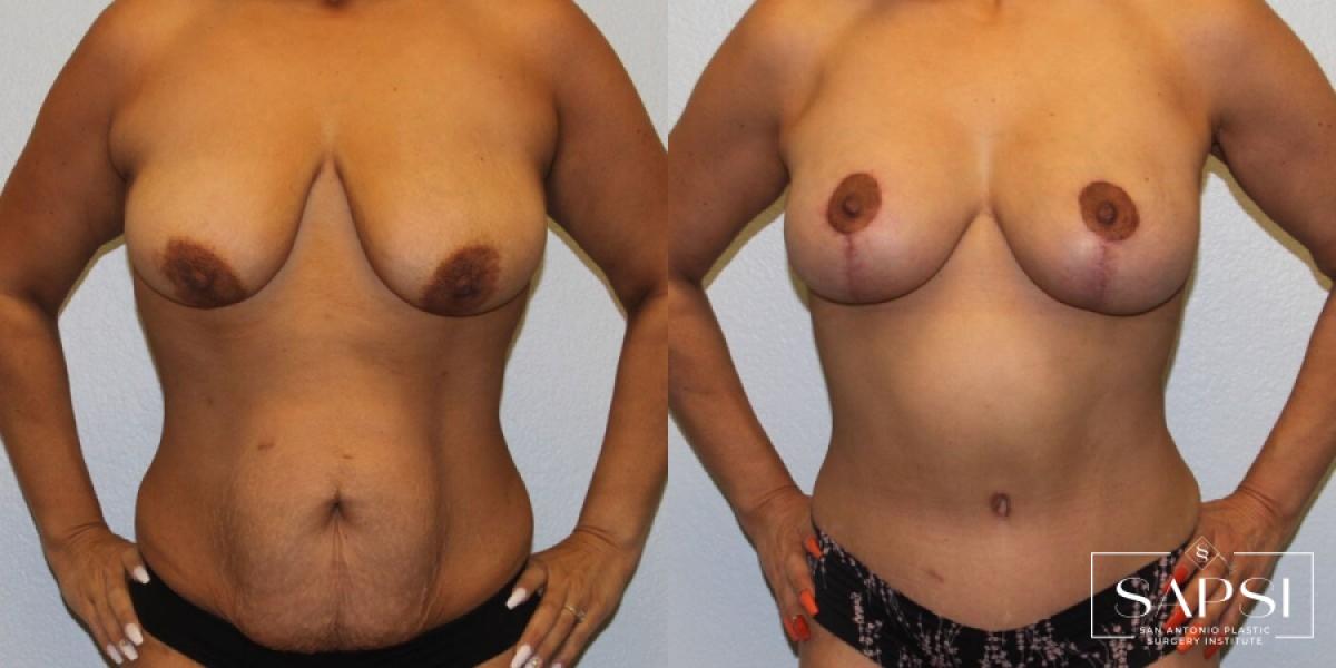 Body Contouring: Patient 8 - Before and After  