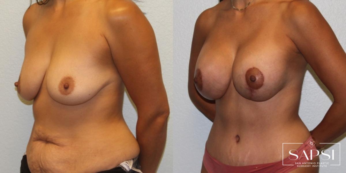 Breast Augmentation With Lift: Patient 8 - Before and After 2