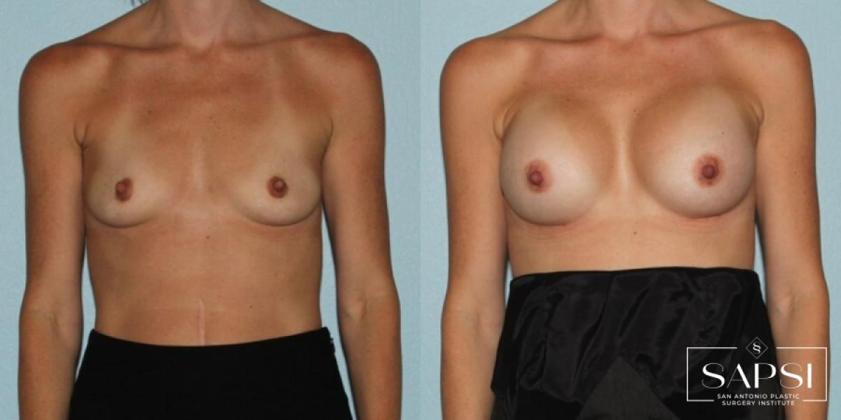 Breast Augmentation: Patient 10 - Before and After  