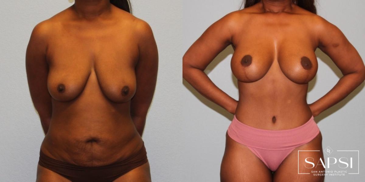 Tummy Tuck: Patient 13 - Before and After 1