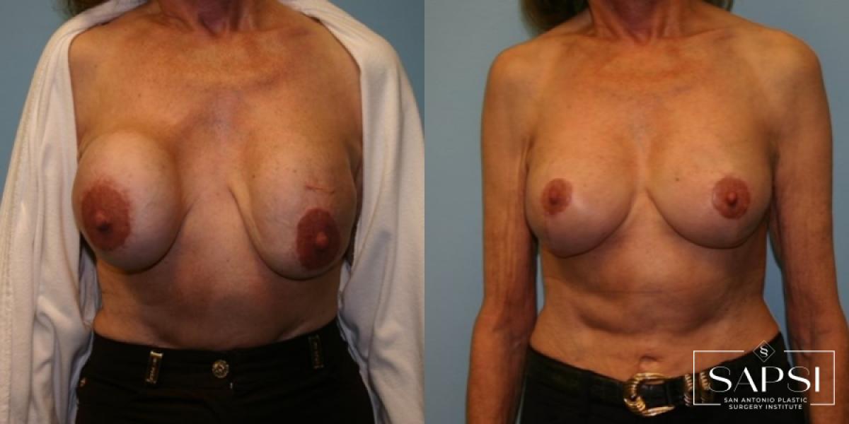 Breast Revision: Patient 9 - Before and After  