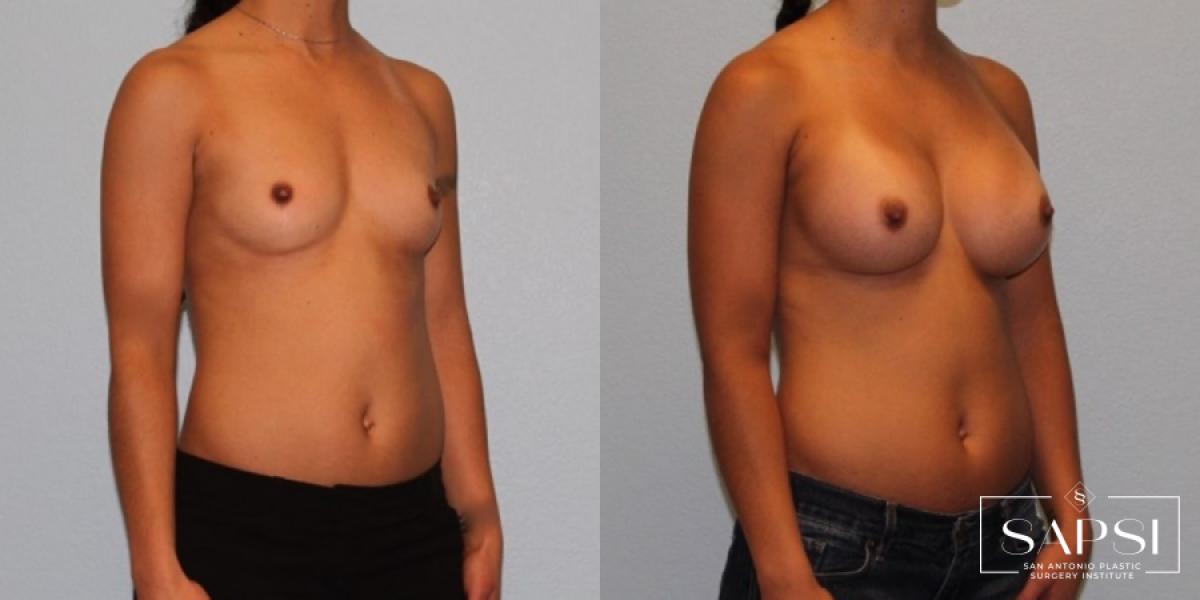 Breast Augmentation: Patient 46 - Before and After 2